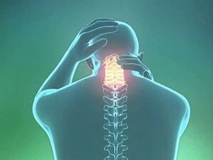 Симптом шейного остеохондроза – головная боль