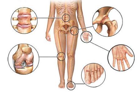 остеоартрит поражает различные суставы